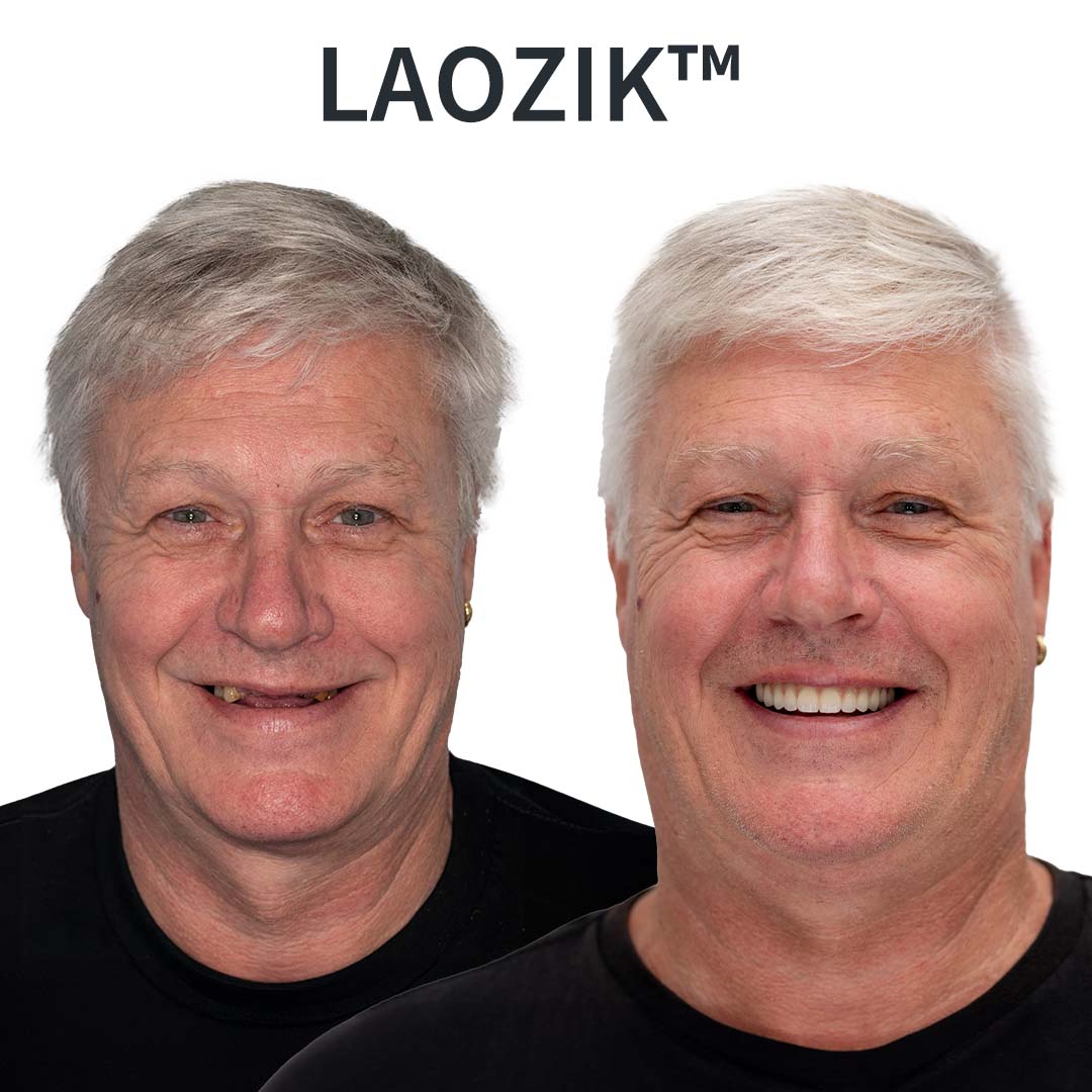 LAOZIKTM AdaptableFit Functional Dentures – Made in the USA & FDA-Certified
